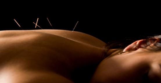 A deeply relaxed person lying on their tummy with very fine acupuncture needles inserted on their upper back